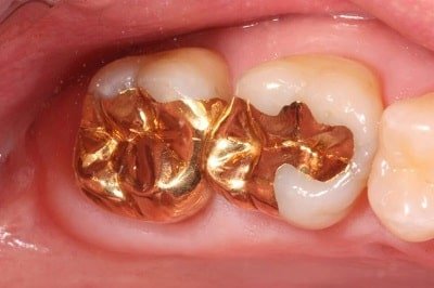 Gold  tooth Fillings