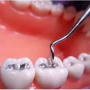 Is Tooth Filling painful or Not