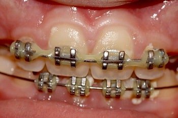 Get Rid of Gingivitis with Braces